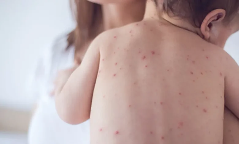 How to Spot Measles Symptoms and Protect Your Family in Gauteng