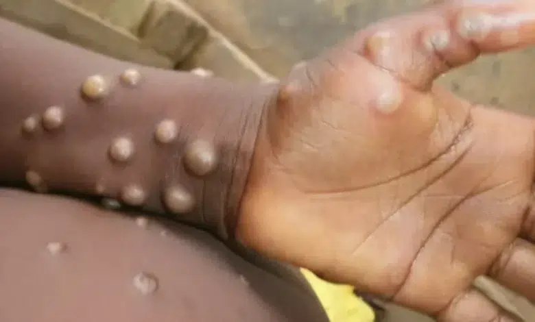 Rising Mpox Infections in South Africa Prompt Health Department Warning