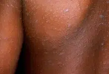 How Schools and Crèches Are Helping Fight Measles Outbreaks in Gauteng
