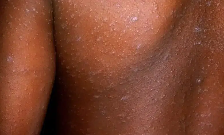 How Schools and Crèches Are Helping Fight Measles Outbreaks in Gauteng